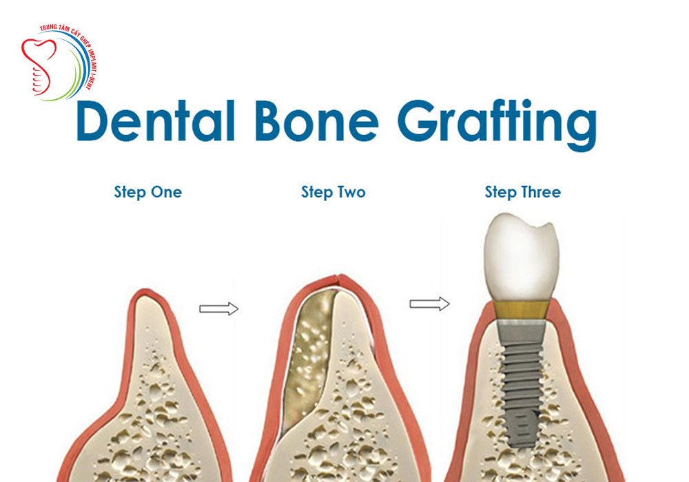 Advantages And Disadvantages Of Materials Used For Bone Graft