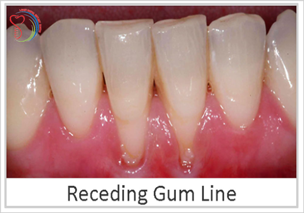 gums receding canine teeth