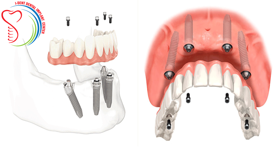 Our Costs - Pearl Dental & Implant Center