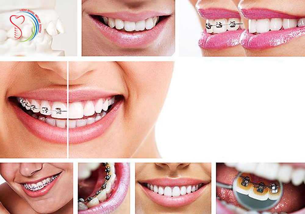 All on four dental implants price in Vietnam