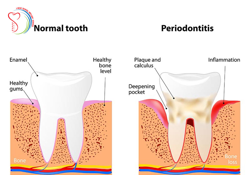 Causes, prevention and treatment for gingivitis