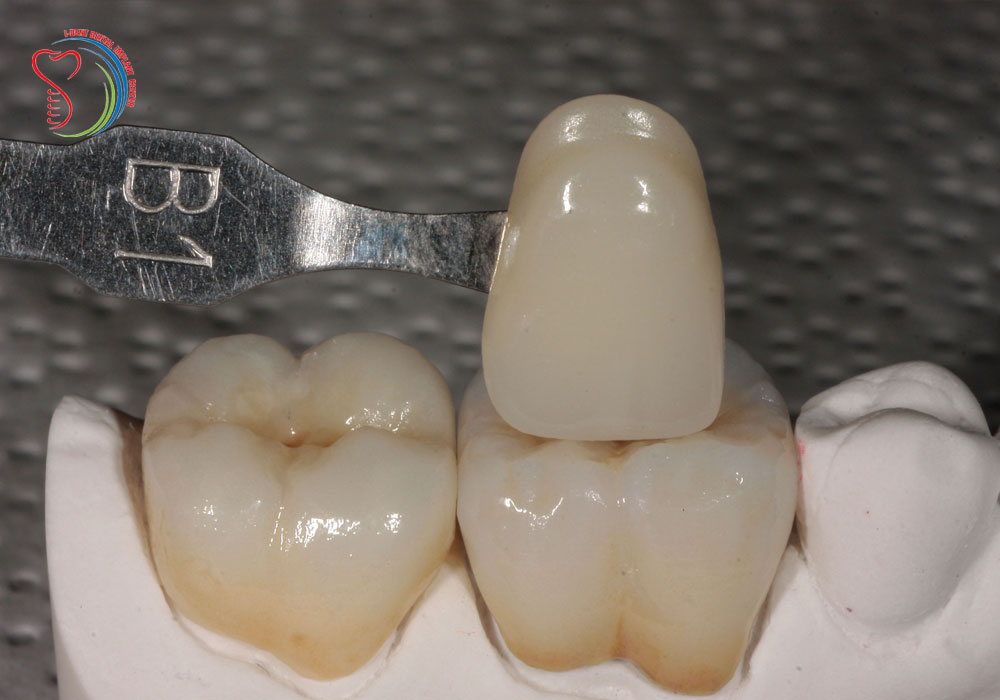 Comparing the difference between zirconia and Cercon porcelain Crowns
