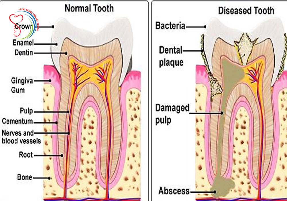 Cure marrow before dental restorations should not