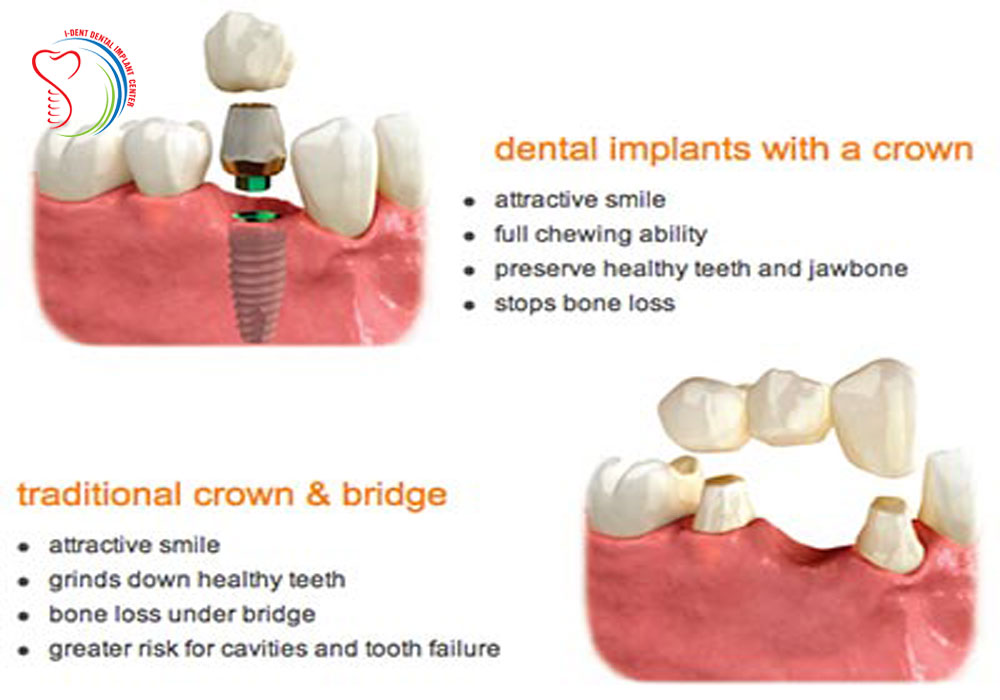 dental bridges vs implants