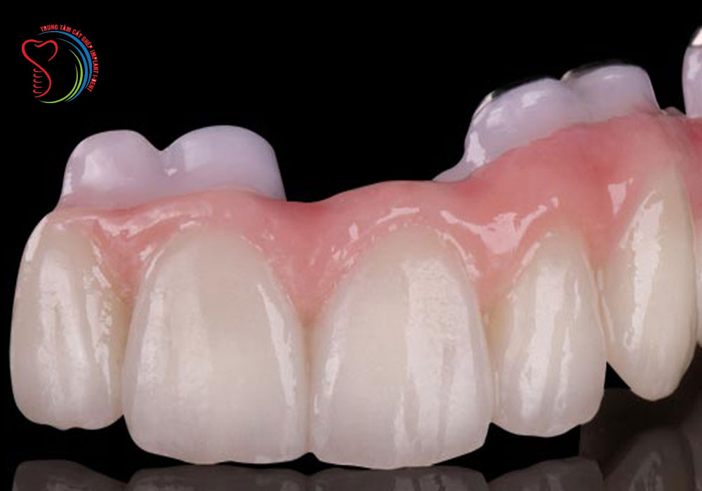 Dental esthetics Metal