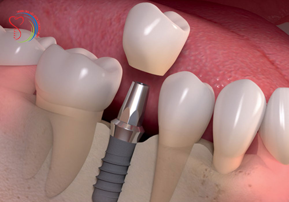 Dental Implant Technique