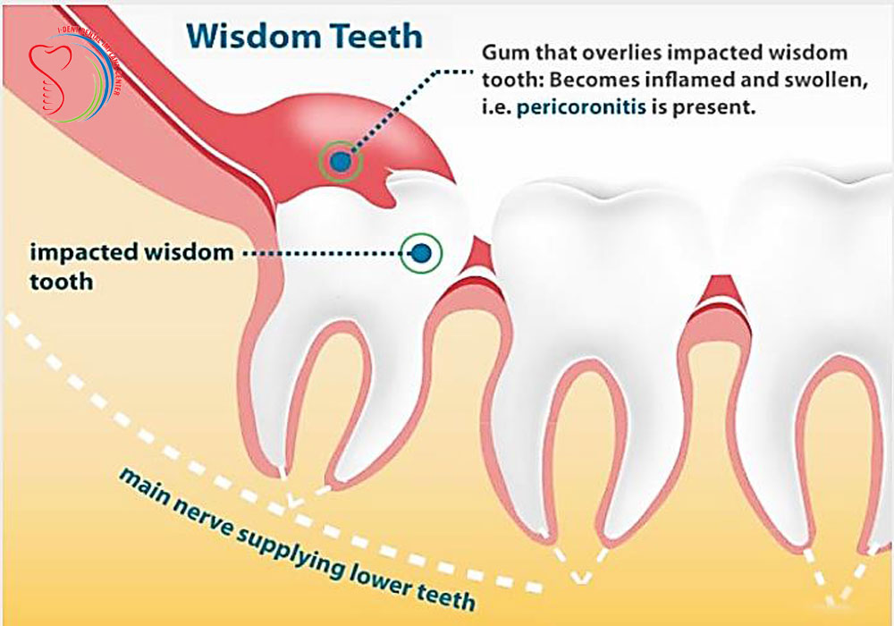 Disease of wisdom teeth