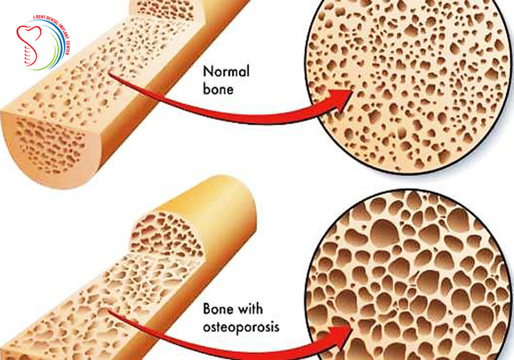 effect-of-bone-density-in-dental-implants