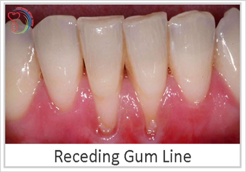 Gum disease: receding gums