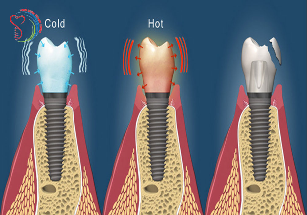 dental-implant-surgery-recovery-minerva-oh