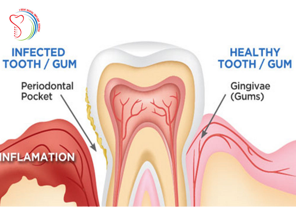 Dental Treatment For Loose Teeth