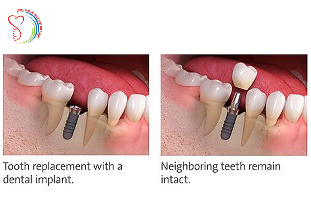 Immediately Dental Implant after Tooth Extraction