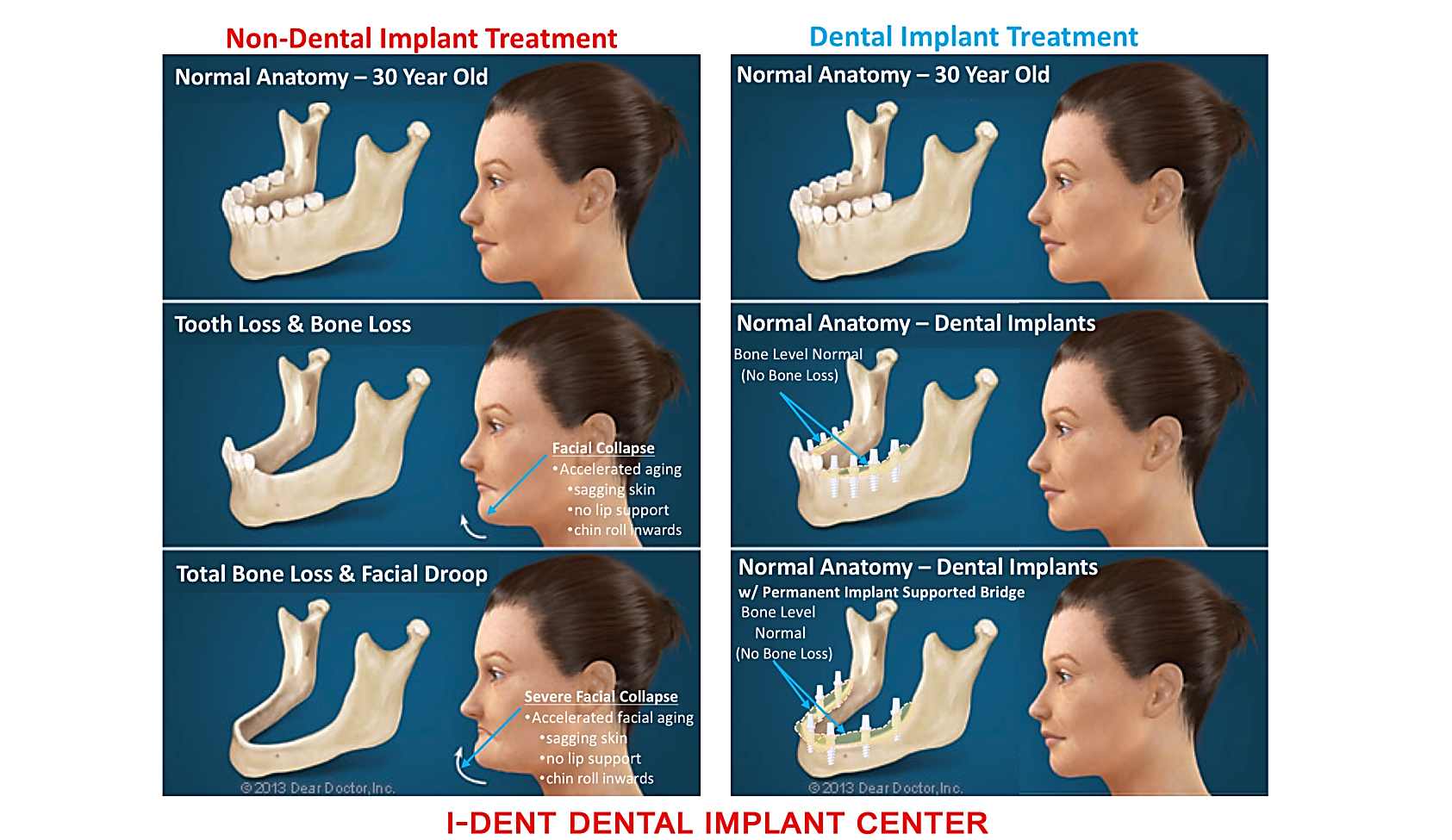 Did you know that the harmful effects of the loss of teeth