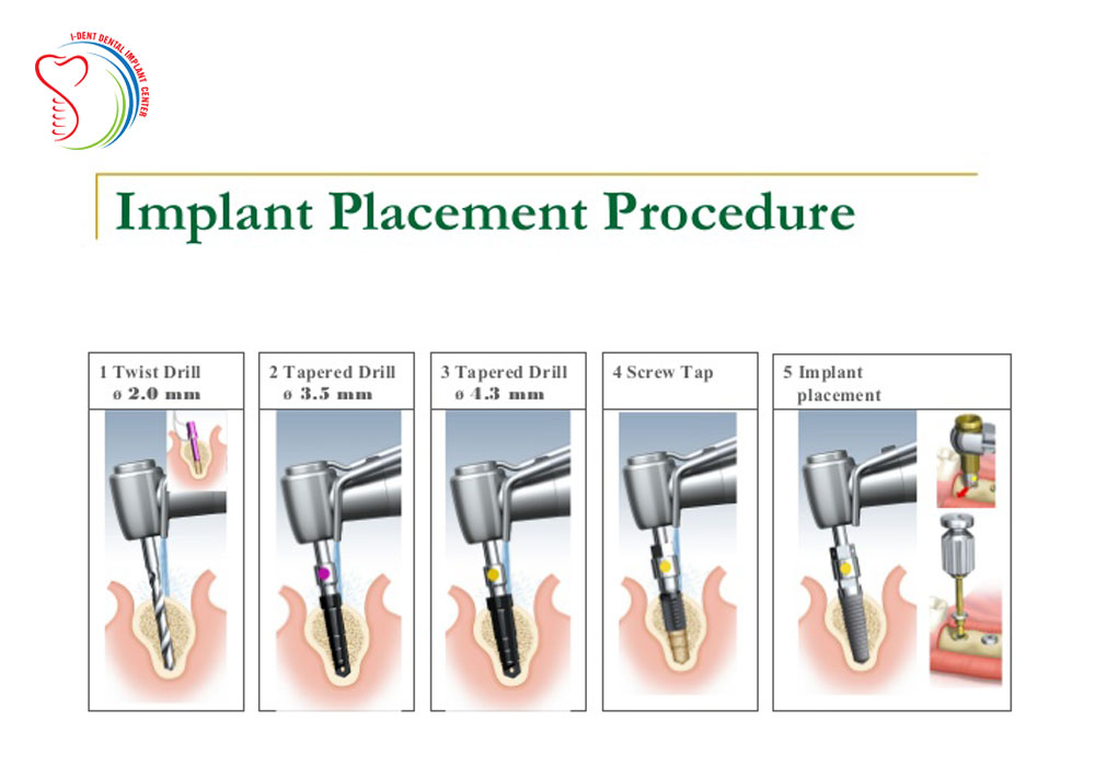 Implant placement - Implant method effective