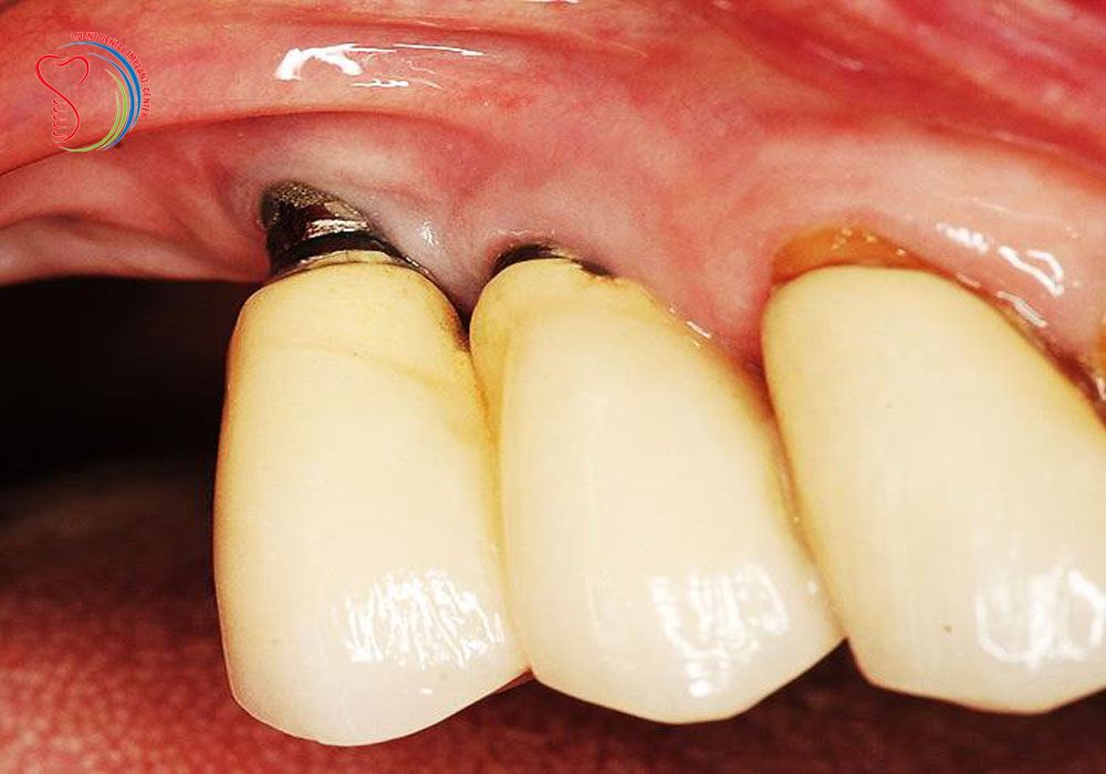 Inflammation around the Root of the Implant Teeth