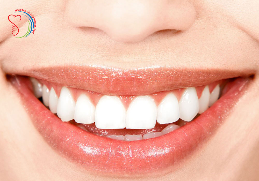 Is Cercon porcelain crown good