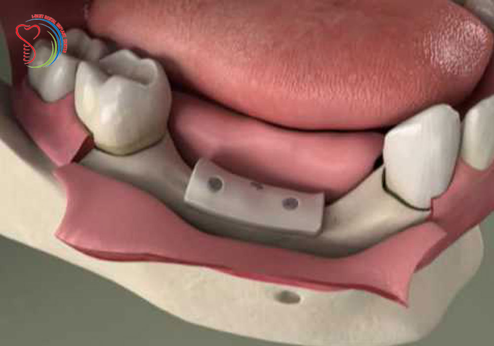 Is Dental Implant right after bone grafting