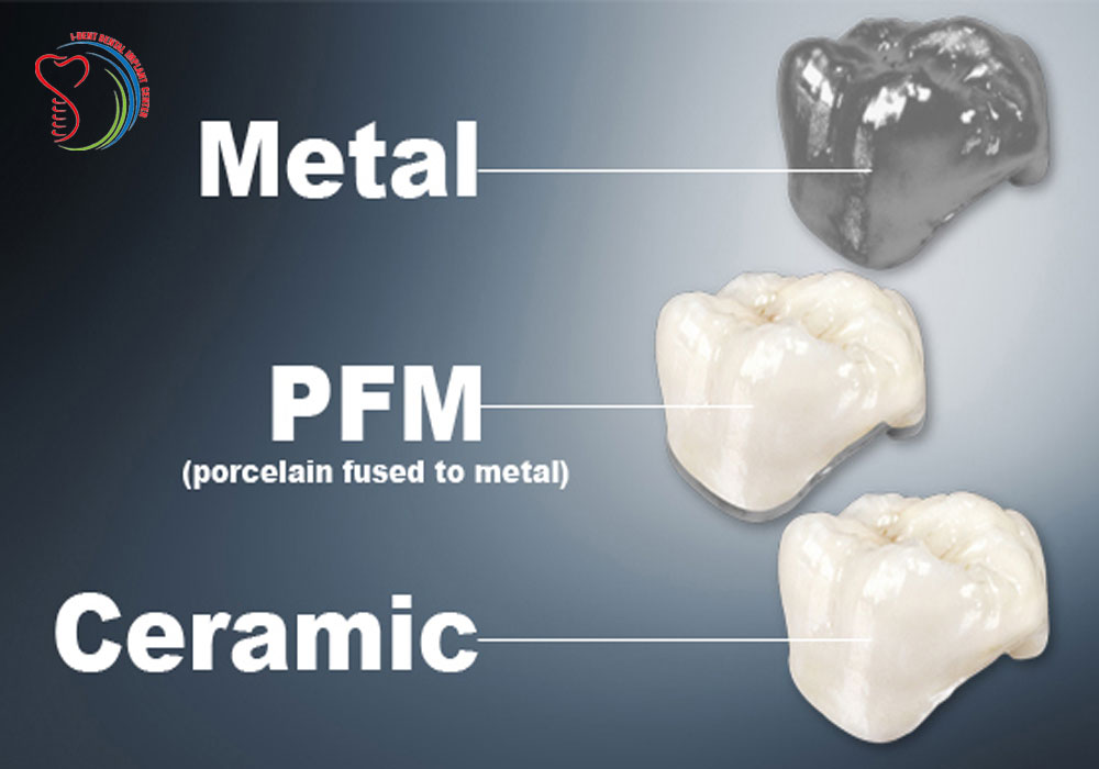 All on four dental implants price in Vietnam