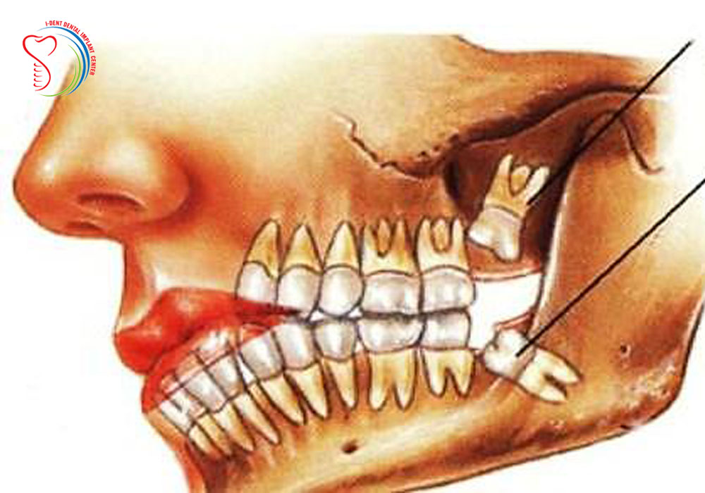 Is the wisdom tooth extraction on top of danger Dental knowledge