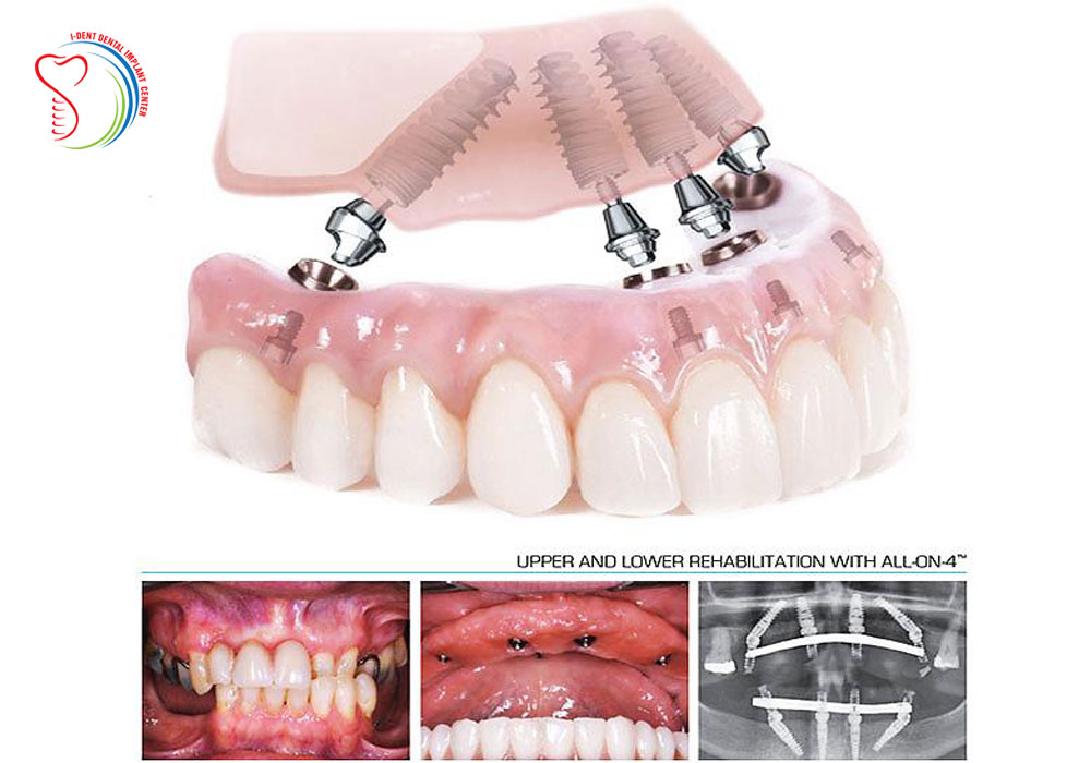 Loss of whole teeth, replanting with weak chewing ability