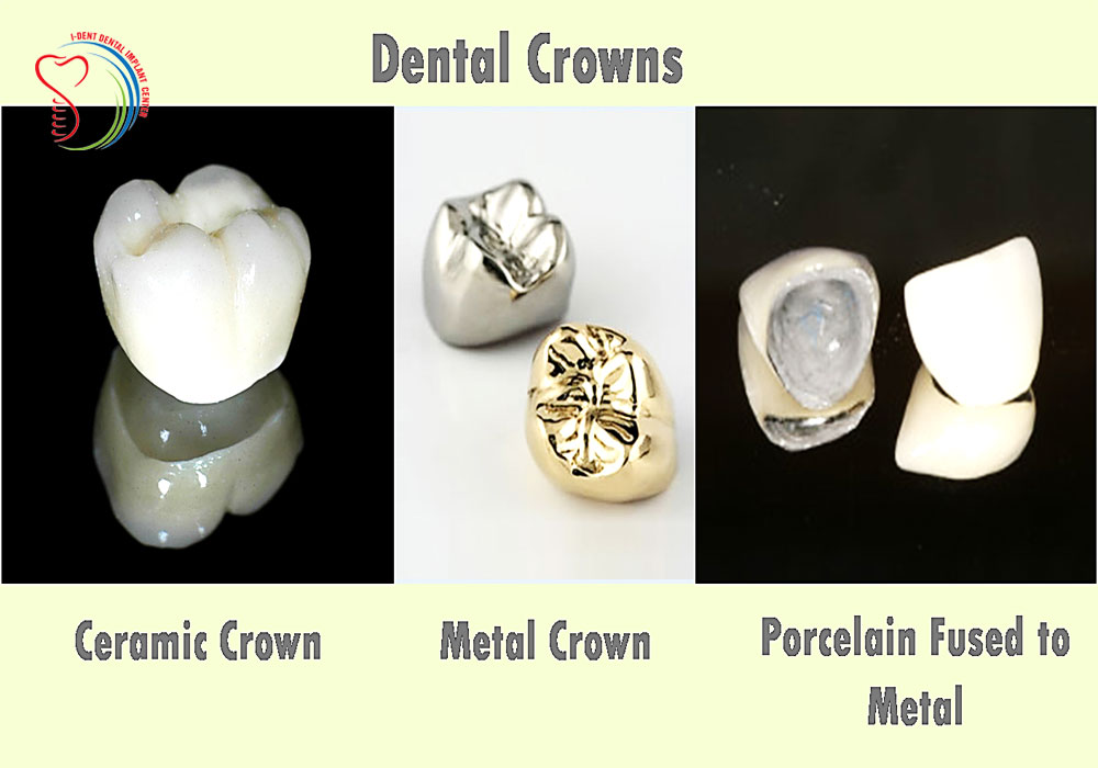 Litoral mereu Luminance dental crown metal ceramic bloc Lacrimi șuncă