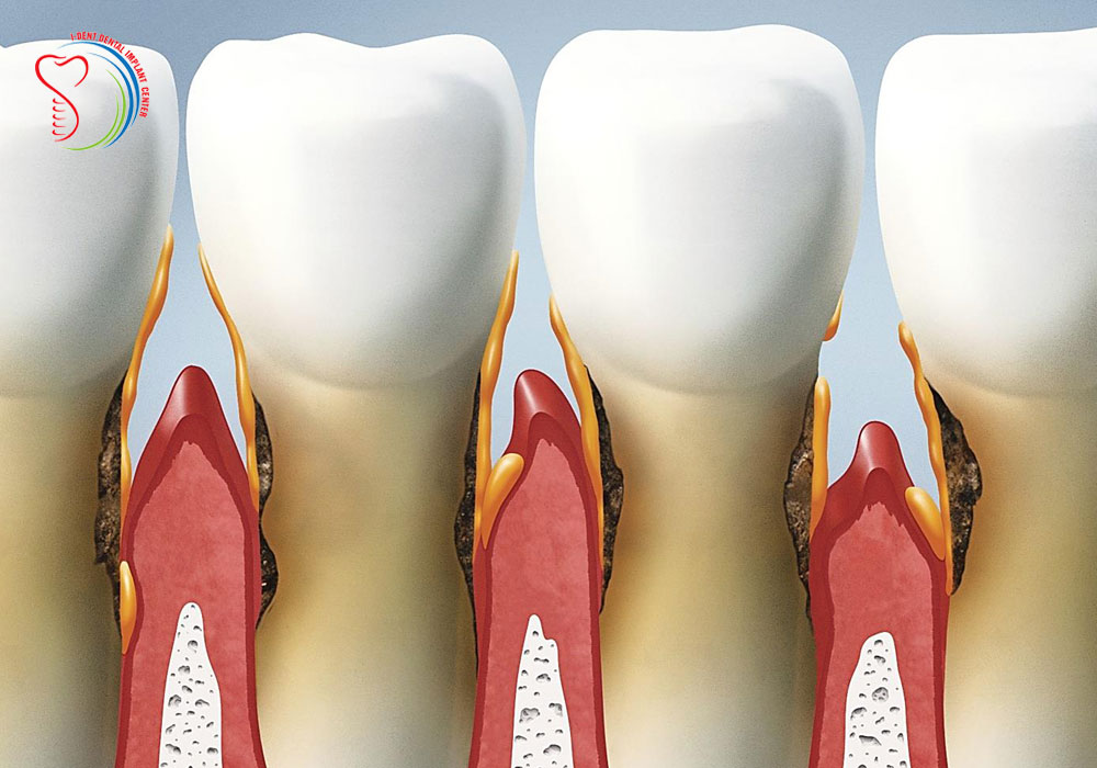 Periodontitis is more scary than the tooth decay
