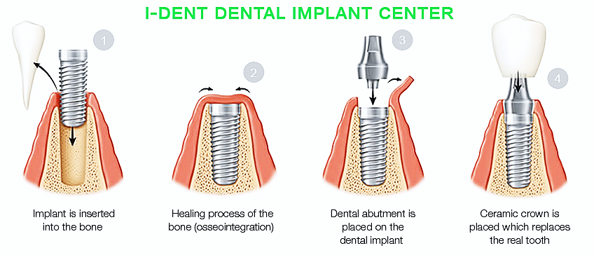  Porcelain crown restorations