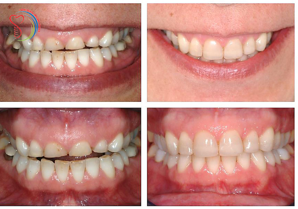 Porcelain tooth for worn incisors are effective