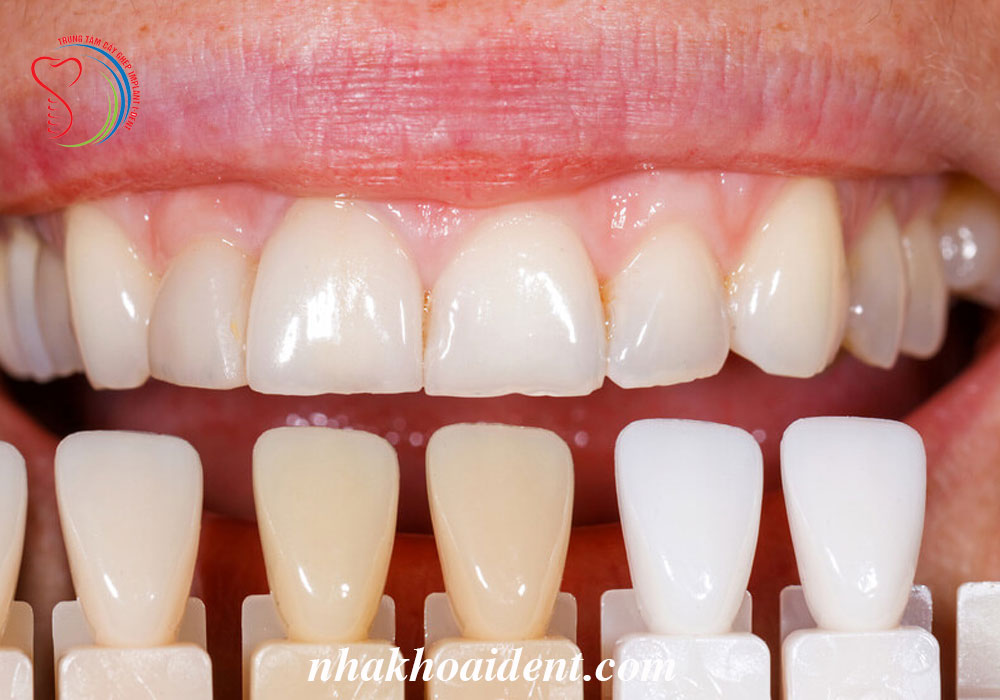 Porcelain veneers Porcelain veneers
