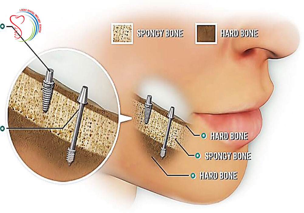 TECHNIQUES OF SINUS LIFT IN DENTAL IMPLANT