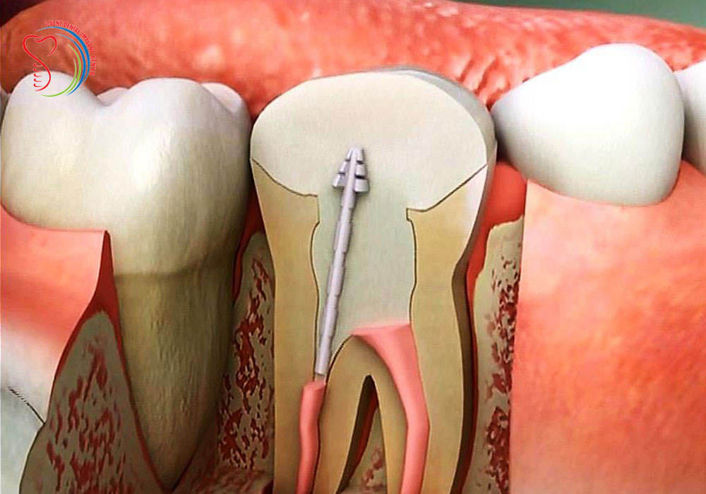What is the cost of full mounth dental implants in Vietnam