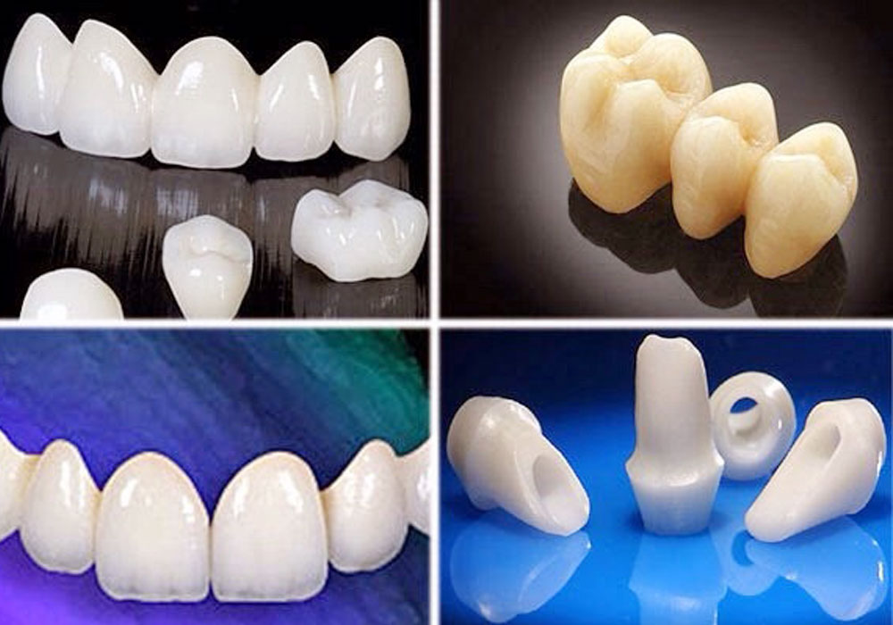 Dental Crown Types: Which Material is Best for You?