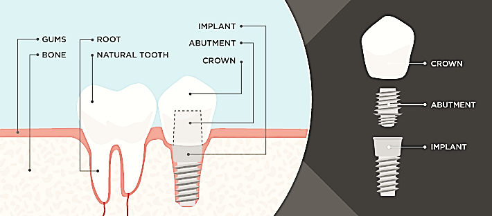 What is dental implant?
