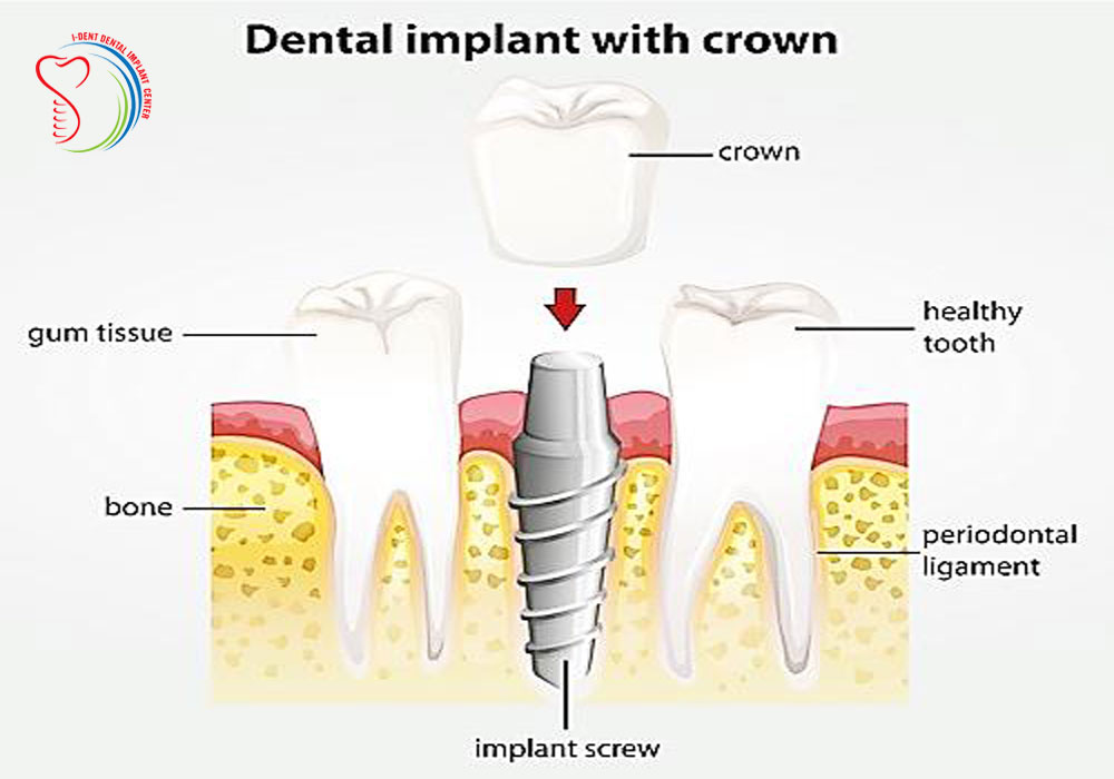 What is the function of getting implant