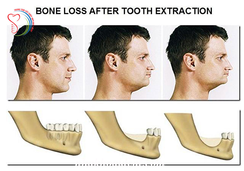 Jaw discount bone exercise