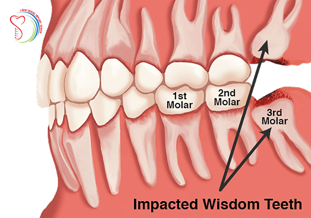 Diagram Of Teeth With Wisdom Teeth - Teeth Poster