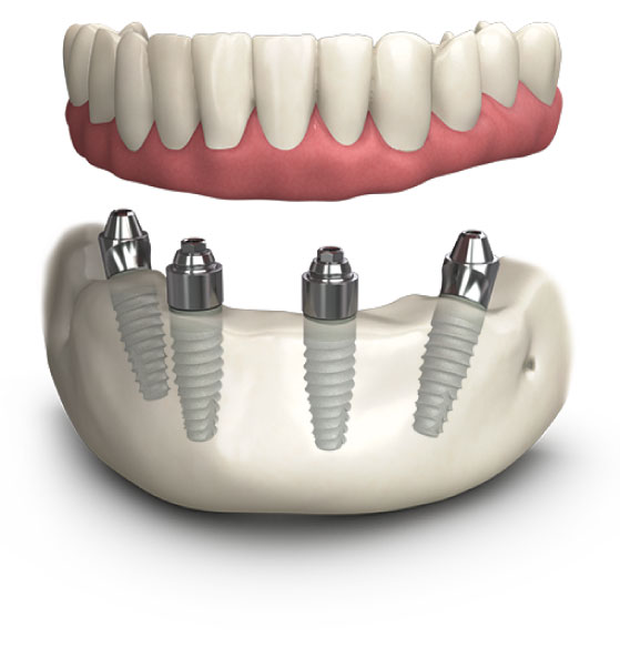 All-on-4-implant