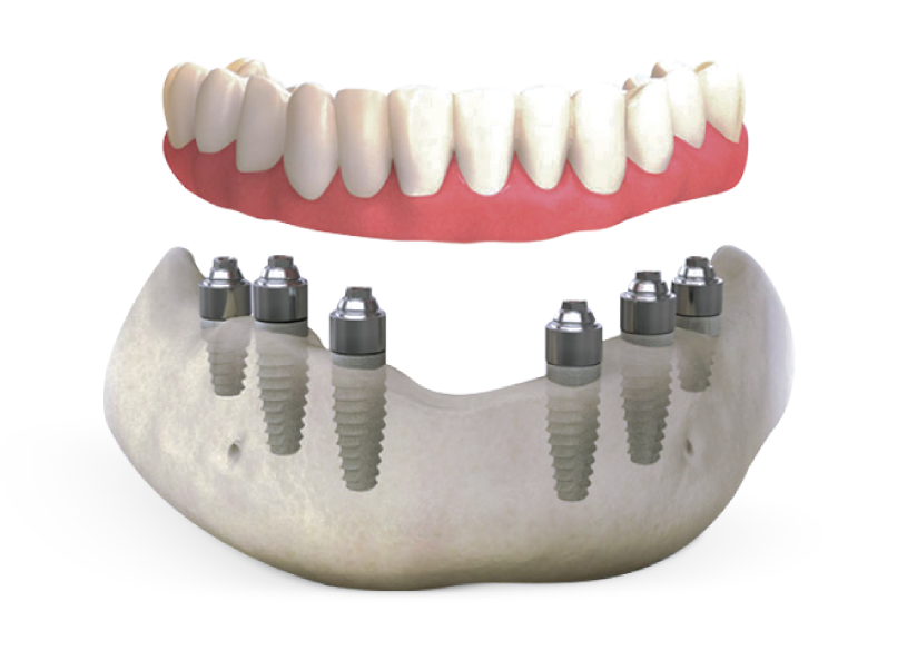 Benefits-of-All-on-6-Denture-Implants