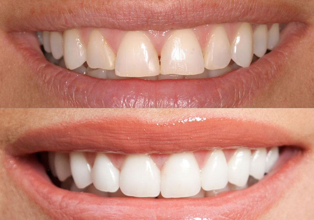 The Restoration Process by Porcelain Crown at I-DENT Dental Implant Center
