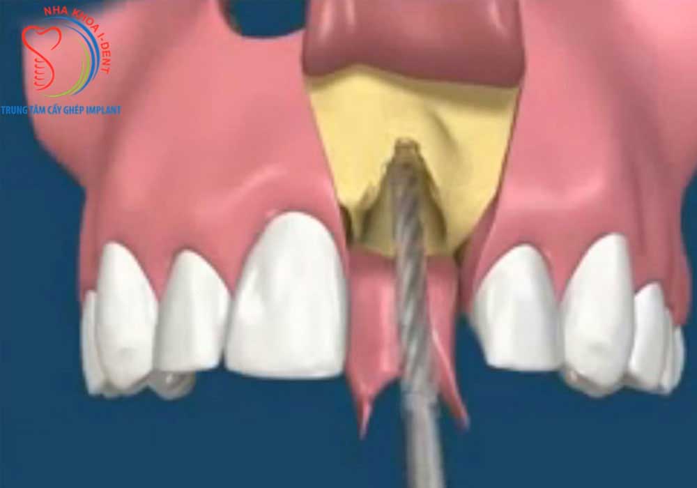 All-On-Four Implant